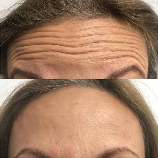 BOTOX STOCK SOLUTION™: 💙 Dale a tu piel el cuidado que se merece todos los días.
